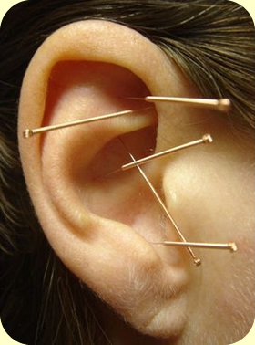 acupuncture